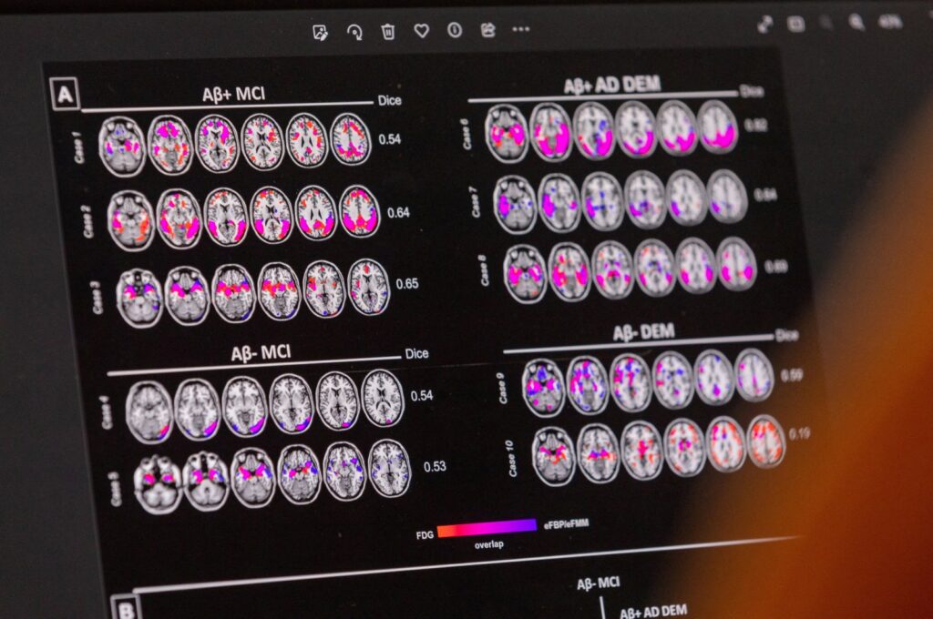 A scientist looks at hypometabolic and hypoperfusion patterns at the single-subject level from a patient suffering from Alzheimer's disease at the Memory Centre at the Department of Readaptation and Geriatrics of the University Hospital (HUG), in Geneva, Switzerland, June 6, 2023. (Reuters File Photo)