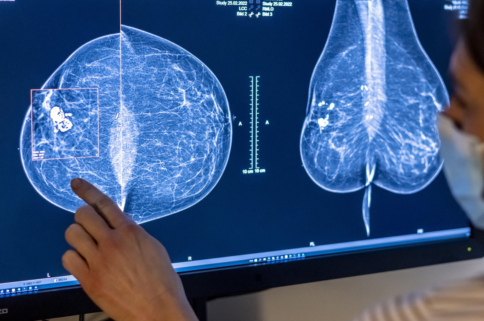 Doctors and scientists from Sweden's Lund University have found that AI-supported mammography screening "almost halved radiologist workload" during a randomized trial under a Swedish national breast cancer screening program. (dpa Photo)