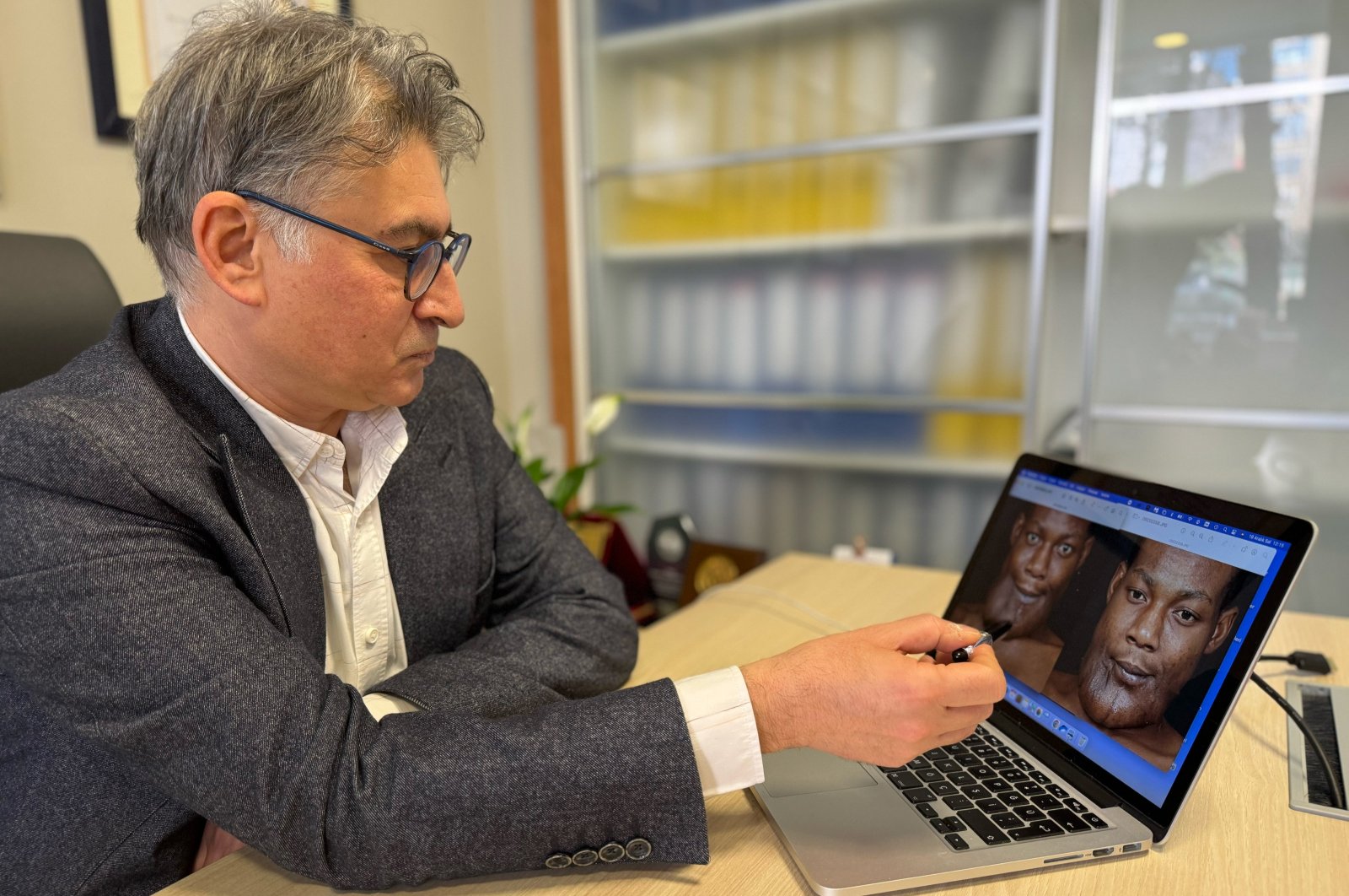 Dr. Ozan Seymen Sezen analyzing Yamayong's benign tumor, Istanbul, Türkiye, Jan. 31, 2024. (AA Photo)