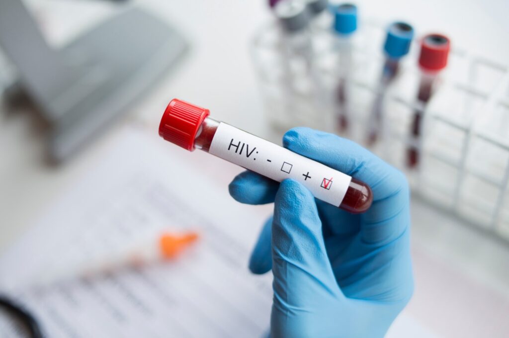 HIV is a virus that attacks the immune system, leading to acquired immunodeficiency syndrome (AIDS). (Shutterstock Photo)