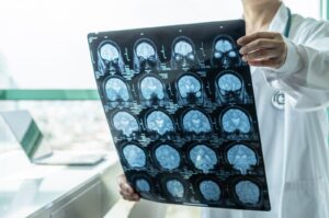 A medical doctor diagnoses neurodegenerative illness in elderly patients using MRI for neurological treatment.
(Shutterstock Photo)