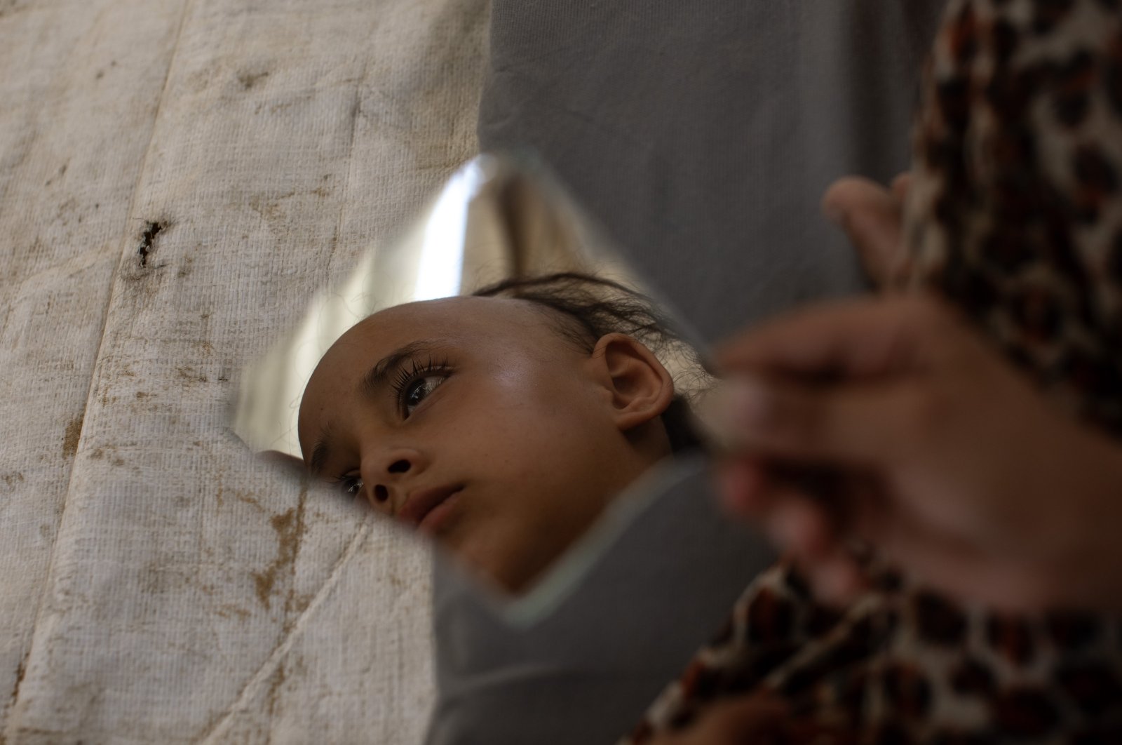 A 13-year-old displaced Palestinian girl, Sama Tabeel, who has suffered from panic attacks and hair loss due to Israeli attacks and evacuation orders, is seen in a mirror, at her family's accommodation in Khan Younis, northern Gaza, Palestine, Aug. 26, 2024. (EPA Photo)