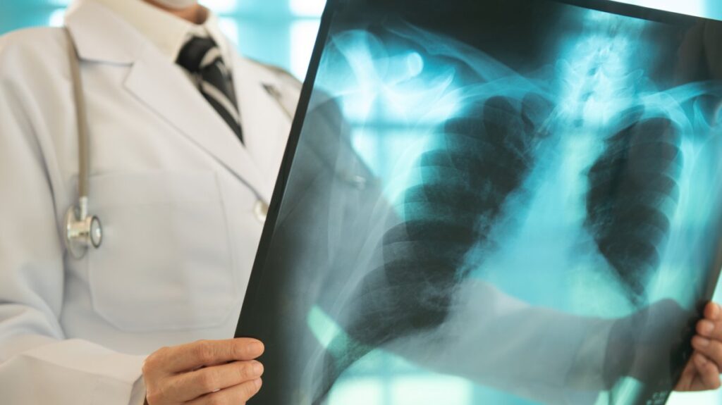 Early screening, especially with lung CT scans for high-risk individuals over 40, is vital to saving lives from this silent disease. (Shutterstock Photo)
