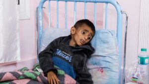 Palestinian boy Osama Al-Reqep, 5, lies on a bed at Nasser Hospital where he receives treatment, Khan Younis, Gaza Strip, Palestine, May 1, 2025. (Reuters Photo)