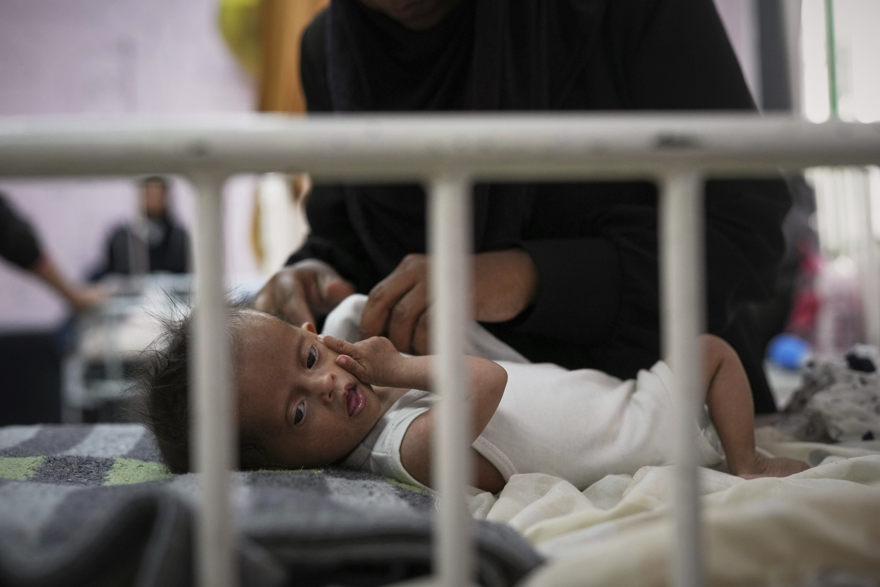380715 Rahma al-Qadi takes care for her 7-month-old daughter Sama, who was born with Down syndrome and suffers from malnutrition, at the malnutrition clinic in Nasser hospital, Khan Younis, Gaza, May 1, 2025. (AP Photo)
