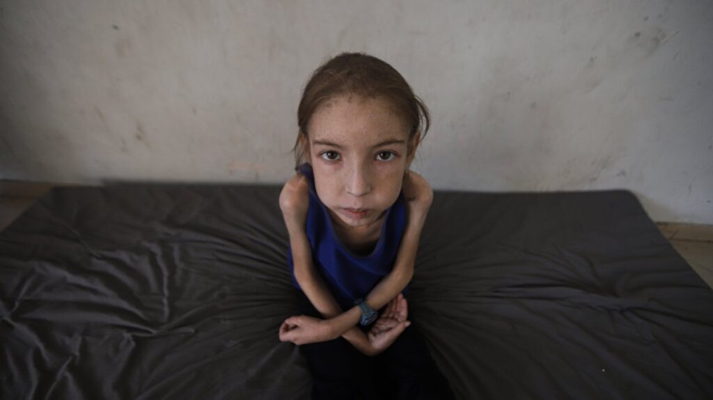 Rahaf Ayyad, 12, is wasting away from an undiagnosed illness made worse by malnutrition, Gaza City, central Gaza Strip, Palestine, May 5, 2025. (AA Photo)