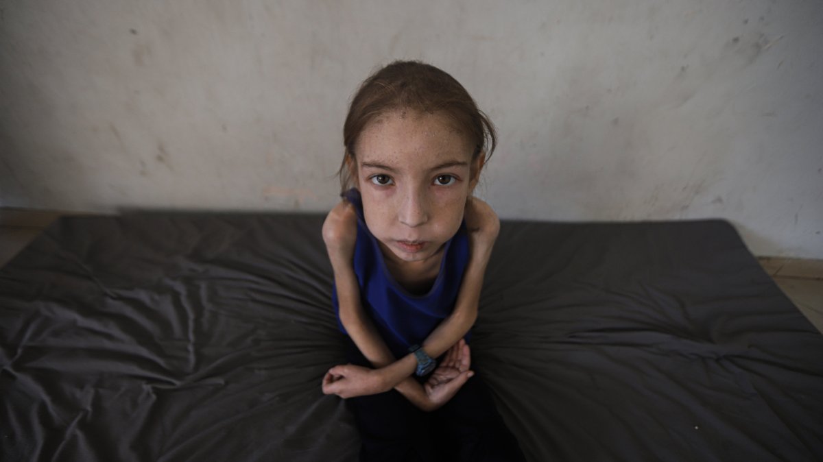 Rahaf Ayyad, 12, is wasting away from an undiagnosed illness made worse by malnutrition, Gaza City, central Gaza Strip, Palestine, May 5, 2025. (AA Photo)