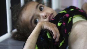 Mayar Al-Arja, 2, who suffers from malnutrition, lies on a bed in a clinic in Nasser Hospital, Khan Younis, Gaza, Palestine, May 21, 2025. (AP Photo)