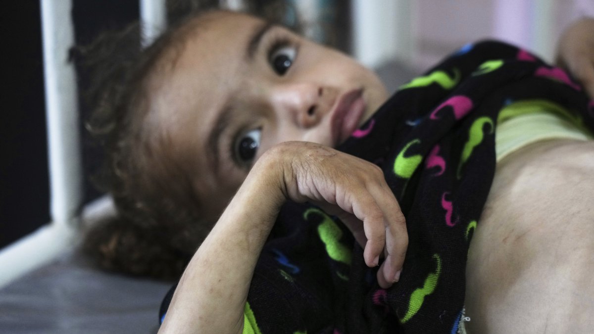 Mayar Al-Arja, 2, who suffers from malnutrition, lies on a bed in a clinic in Nasser Hospital, Khan Younis, Gaza, Palestine, May 21, 2025. (AP Photo)