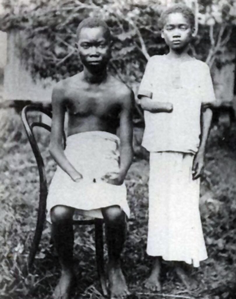 Amputation was frequently used to punish workers in the Congo Free State, controlled by Leopold II of Belgium, 1900.