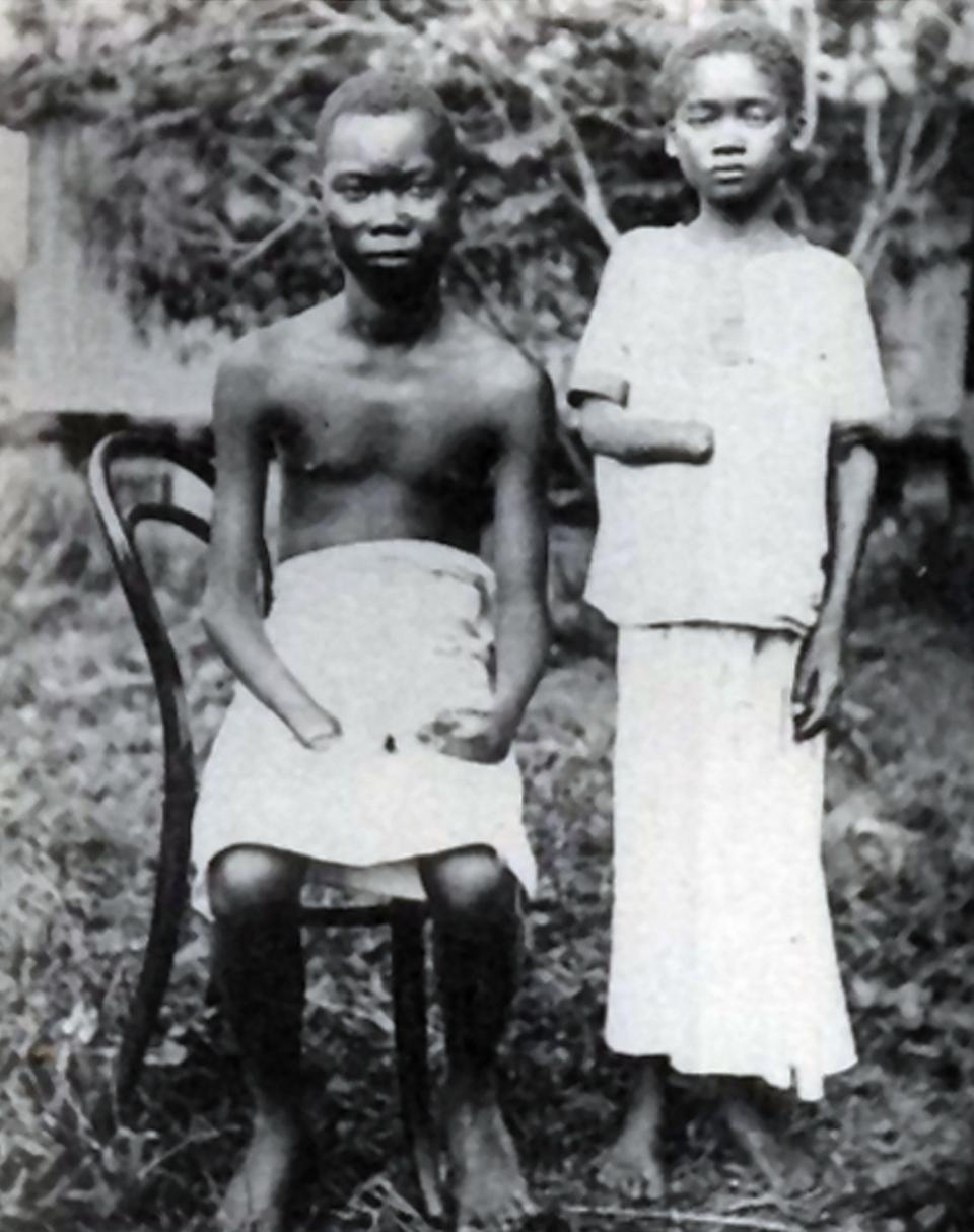 Amputation was frequently used to punish workers in the Congo Free State, controlled by Leopold II of Belgium, 1900.